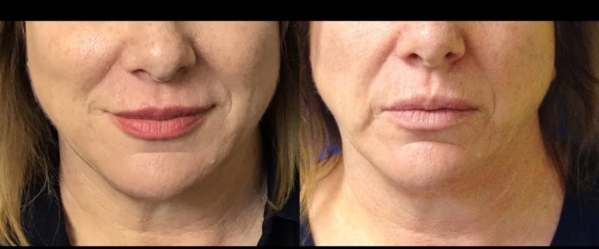Smoothing Smokers Lines with Dermal Fillers