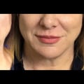 Smoothing smokers lines with dermal fillers