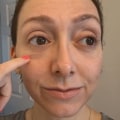 Can cheek fillers reduce under-eye bags?