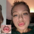 Are lumps after fillers normal?