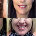 How to Hide a Gummy Smile with Lip Fillers