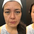 How long does dermal filler pain last?