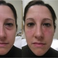 What are facial fillers and how do they work?