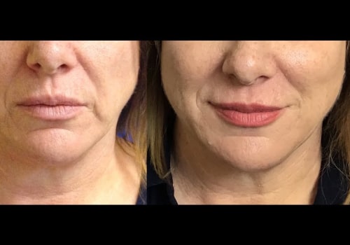 Smoothing smokers lines with dermal fillers
