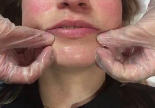 Massaging filler lumps: what you need to know