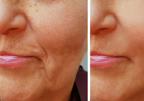 What is the most common dermal filler used for wrinkles?