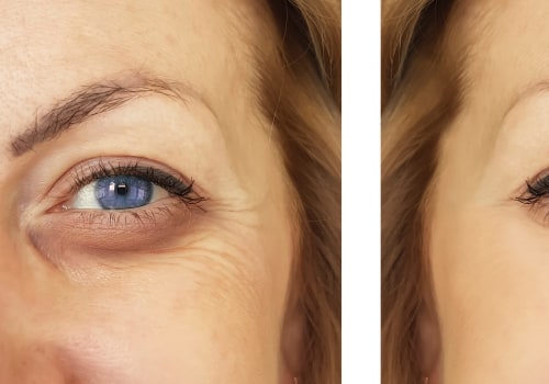 Can dermal fillers help eye bags?