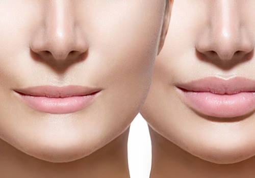 Which lip filler gives the most volume?