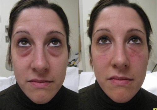 The benefits of dermal fillers: how to look younger without surgery or downtime