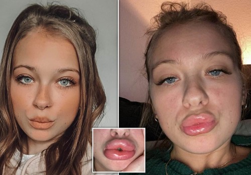Are lumps after fillers normal?