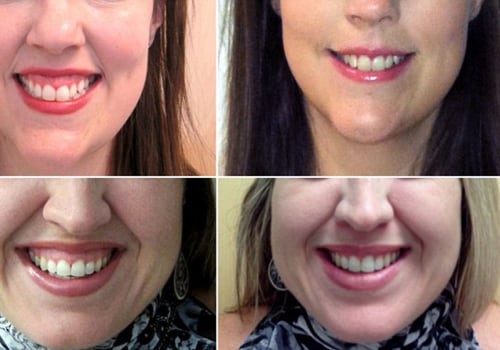 How to Hide a Gummy Smile with Lip Fillers