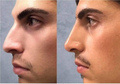 Can dermal fillers last forever?