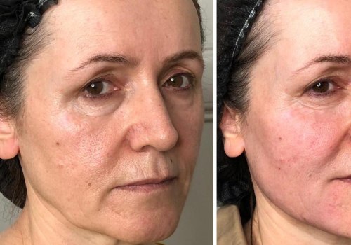 Can dermal fillers help jowls? a comprehensive guide