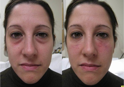 What are facial fillers and how do they work?