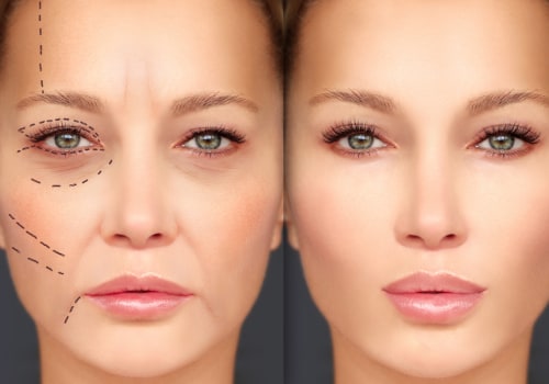 The Benefits of Dermal Fillers: A Comprehensive Guide